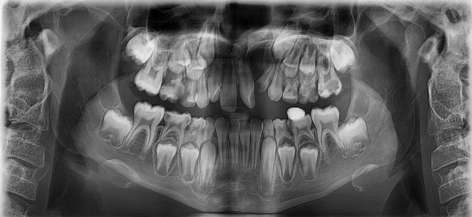 Patient with diastema in the midline of the maxilla caused by a cleft of the alveolar process on the left side and hypodontia of tooth 22 nych (mikrodoncję) szerokość koron zębów siecznych górnych