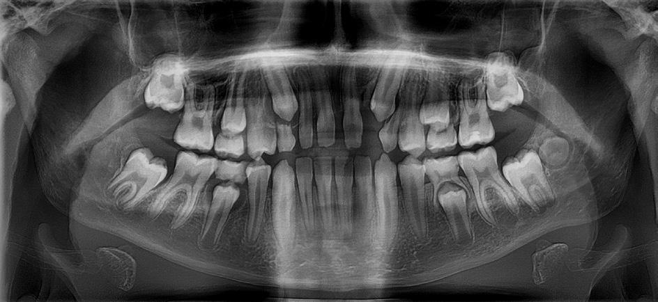 Patient with diastema resulting from hypodontia of tooth 22 and microdontia of the incisors in the maxilla tal abnormalities in the form of hypodontia of tooth 15, an abnormal position of the buds of