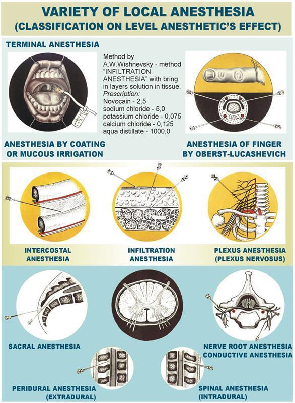 Odmiany znieczuleń