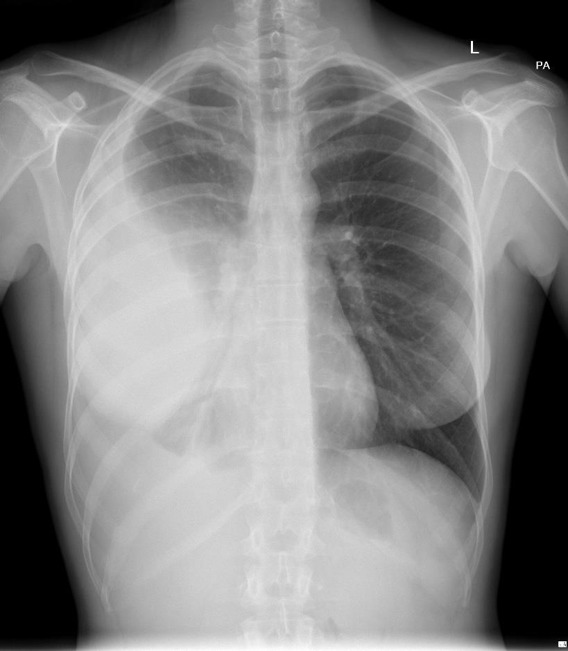 Radiogram klatki piersiowej Częściowo otorbiony płyn w prawej jamie opłucnowej.