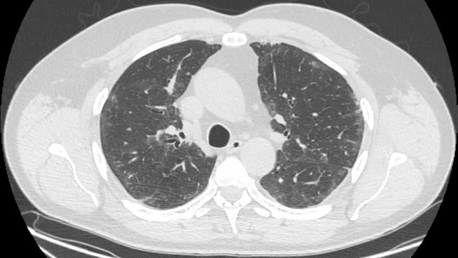 CT klatki piersiowej W obu płucach podopłucnowe niewielkie zmiany włókniste, zmiany nieco silniej wyrażone w płatach górnych.
