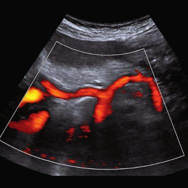 Żyła śledzionowa jest zlokalizowana głęboko w stosunku do trzonu trzustki. Należy zwrócić uwagę, że lewa żyła nerkowa biegnie między żyłą krezkową górną a aortą. (Ryc.