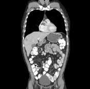 Zespół Turcota nowotwory oun (medulloblastoma, wyściółczaki, gwiaździaki, GBM) zwiększone