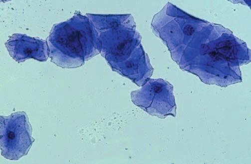 W obrazie cytologicznym widoczne liczne komórki nabłonkowe powierzchowne skeratynizowane, tło przejrzyste. Komórki wyglądają jak zatopione w wodzie (barwienie Hemacolor); Ryc. 5.