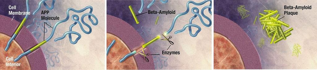 SLAJD 3: Choroba Alzheimera obkurczenie mózgu Choroba Alzheimera charakteryzuje się zanikiem w płatach skroniowych, ciemieniowych i czołowych.