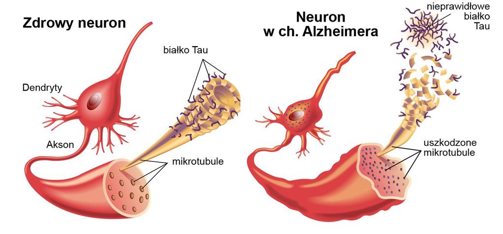 SLAJD 5: Patogeneza - hiperfosforylowane białko tau Białko tau odpowiada za łączenie się mikrotubul i stabilizację. Powinowactwo białka tau do mikrotubul zależy od stopnia jego fosforylacji.