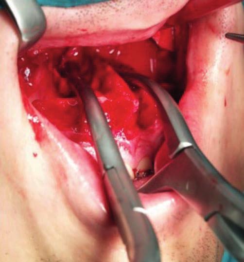 9 ETAP usunięcie pozostałości przegrody nosa od strony dna nosa Kleszczami kostnymi Luera od strony dna nosa należy usunąć pozostałości przegrody nosa, a w przypadku impakcji szczęki dodatkowo