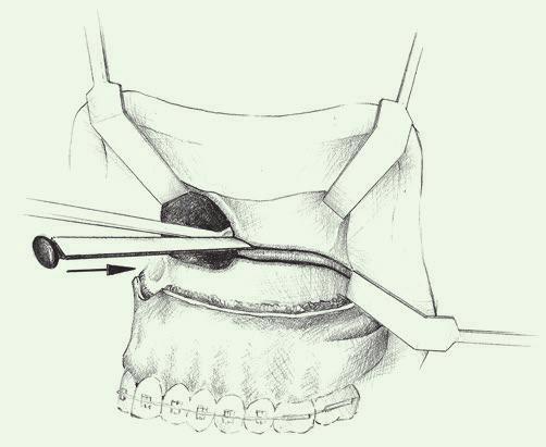 W: Betts N.J., Turvey T.A.: Orthognathic Surgery. W: Fonseca R.J.: Oral and Maxillofacial Surgery. W.B. Saunders Co, Philadelphia 2000, vol. 2, 232 248) Ryc. 5.