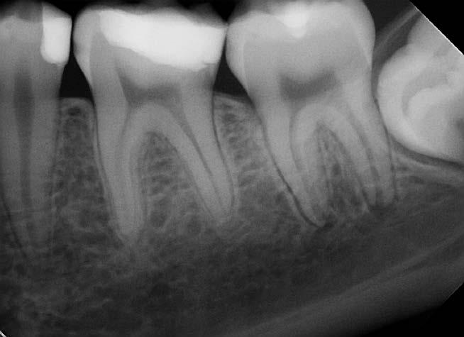 Dyskusja Miazga zębów pełni funkcję bariery chroniącej organizm przed wnikaniem drobnoustrojów ze środowiska jamy ustnej.