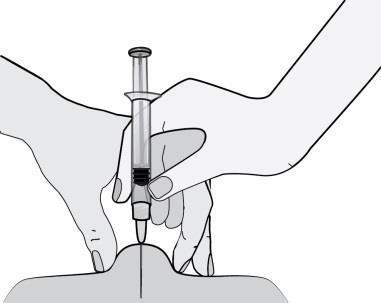5) Przytrzymać ampułko-strzykawkę (jak ołówek) w ręce używanej do pisania, a drugą ręką delikatnie ścisnąć pomiędzy kciukiem i palcem wskazującym oczyszczone miejsce na brzuchu, tworząc fałd skórny.