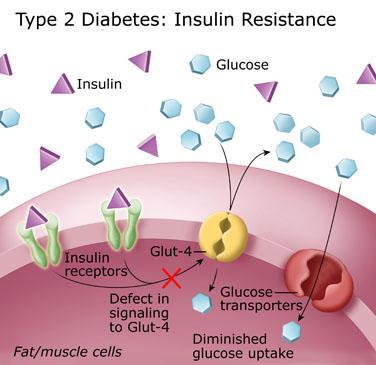 Cukrzyca typ 1 brak insuliny