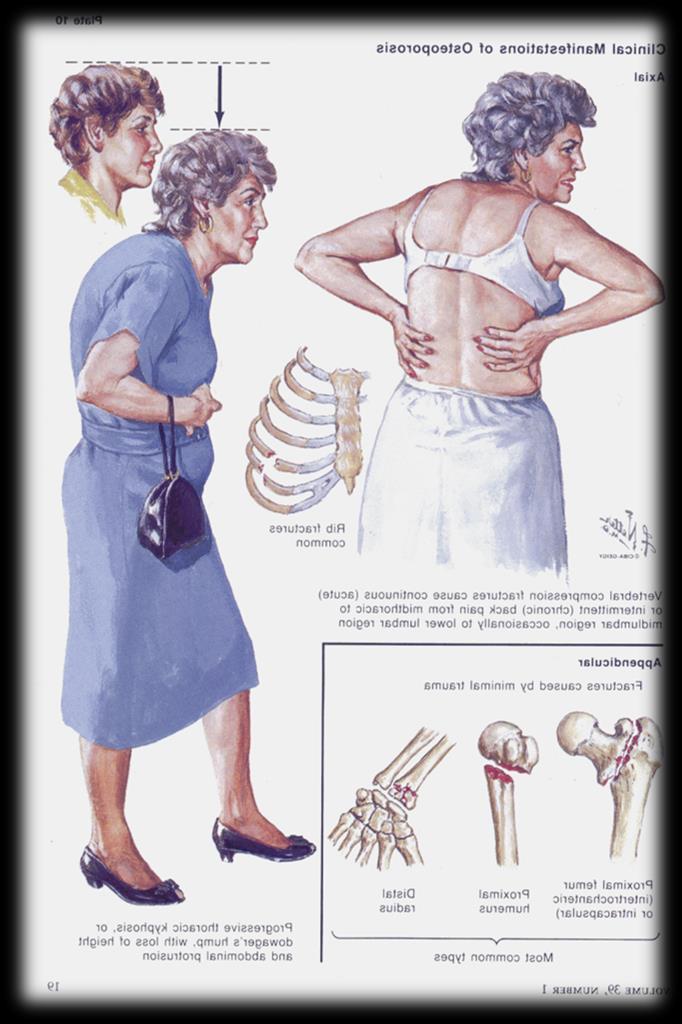 Kliniczna diagnostyka osteoporozy Wywiad chorobowy i badanie przedmiotowe: - Pogłębienie kifozy; - Deformacja klatki piersiowej; - Złamania samoistne; - Utrata wysokości ciała; - Ból; -