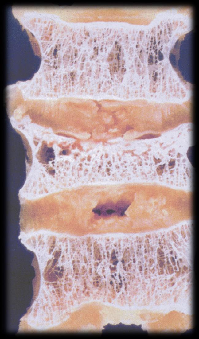 Definicja wg WHO, IOF 1994: Osteoporoza, to układowa choroba kośćca, charakteryzująca się niską masą kostną oraz zaburzeniem mikroarchitektury tkanki kostnej, prowadząca do kruchości kości, a w