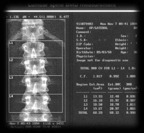 Metoda DXA (centralna) w diagnostyce osteoporozy zalecenia ISCD ISCD Position Statement - Najniższa wartość BMD z następujących