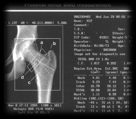 (prawe lub lewe biodro, total lub szyjka kości udowej) powinna być wykorzystana do diagnostyki osteoporozy, pod warunkiem, że pomiary są