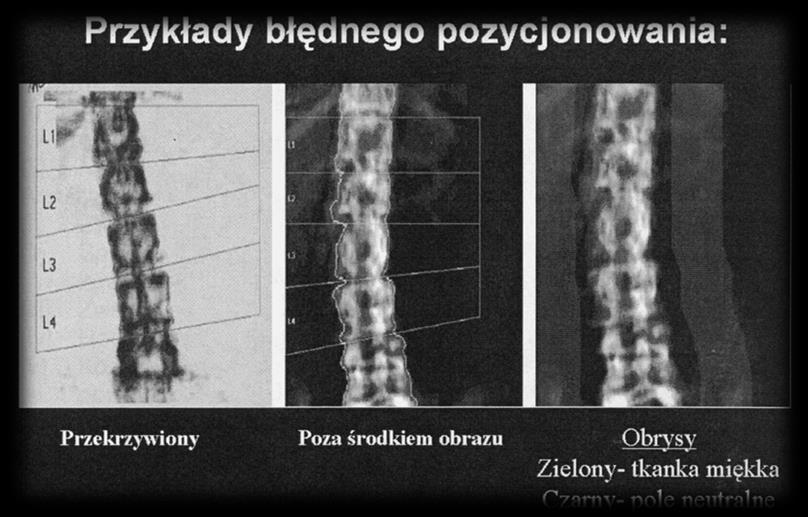 Kręgosłup lędźwiowy w projekcji (PA), optymalne pozycjonowanie: