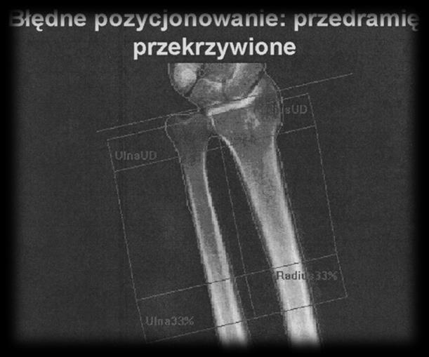 Dalszy koniec przedramienia, optymalne pozycjonowanie Przedramię na