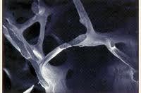 Kompleksowe leczenie osteoporozy 1. Eliminacja czynników ryzyka 2. Leczenie farmakologiczne 3. Leczenie usprawniające 4.