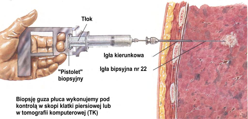 Biopsja transtorakalna technika