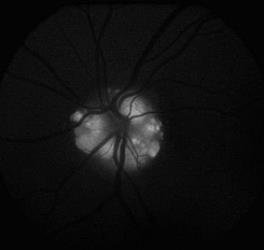 Fluoresceina a autofluorescencja Optic disc