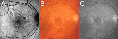 FAF a funduskamera An elderly woman presented with choroidal neovascularization in the left eye and soft drusen in the right eye.