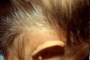 Jak rozpoznać wszawicę głowy: Skóra głowy pokryta grudkami Swędzenie, zaczerwienienie skóry