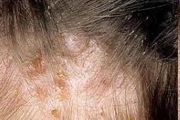 choroby Widoczne są gnidy: -małe, owalne, szarobiałe -przyklejone do włosa blisko nasady