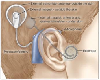 aparaty słuchowe implanty kostne,