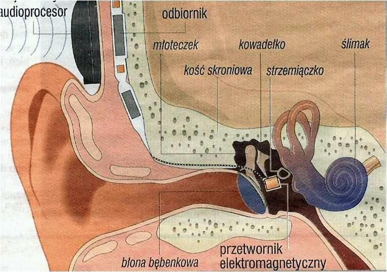 Implant ucha środkowego przekazuje wzmocniony