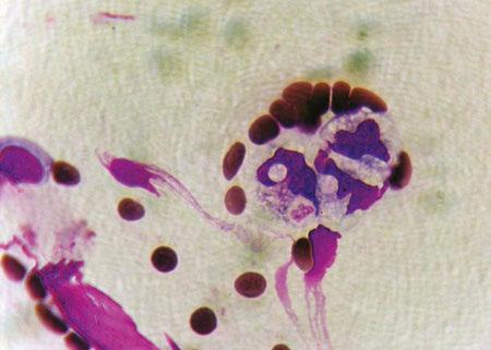 Makrofag erytrocyty z babeszjami i neutrofila (hemoliza zewnątrznaczyniowa) Ryc. 25. Mycoplasma canis. Ryc. 27. Płytki w zlepach psudotrombocytopenia w babeszjozie. Ryc. 29. Erytrofagocytoza B.