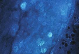 Znakowanie immunohistochemiczne wykazujące obecność receptorów interleukiny 2 na tych neuronach.