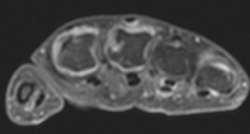 Wczesna diagnostyka BME jest niezależnym predyktorem progresji radiograficznej MRI pozwala