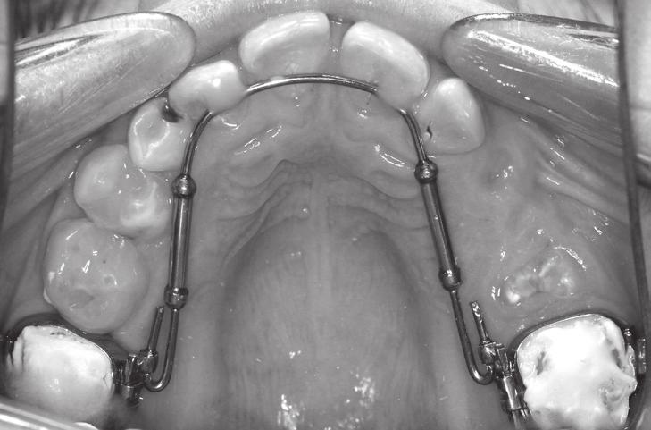 Wczesne i odległe następstwa reinkluzji w materiale własnym 79 Rycina 6. Aparat Transforce Sagittal. Figure 6. Transforce Sagittal appliance Rycina 7. Aparat stały cienkołukowy.