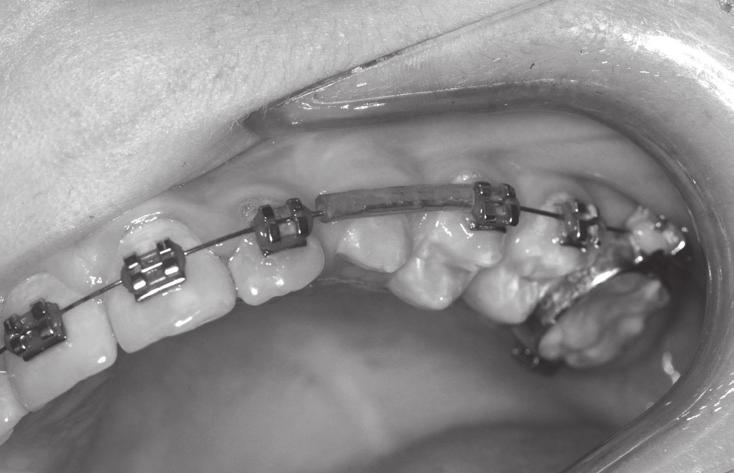 Space for teeth 23, 24 and 25 was recreated PRZYPADEK NR 3 Pacjentka, lat 10, zgłosiła się do Poradni Ortodoncji UCS GUMed skierowana przez lekarza dentystę, który zaobserwował postępujące