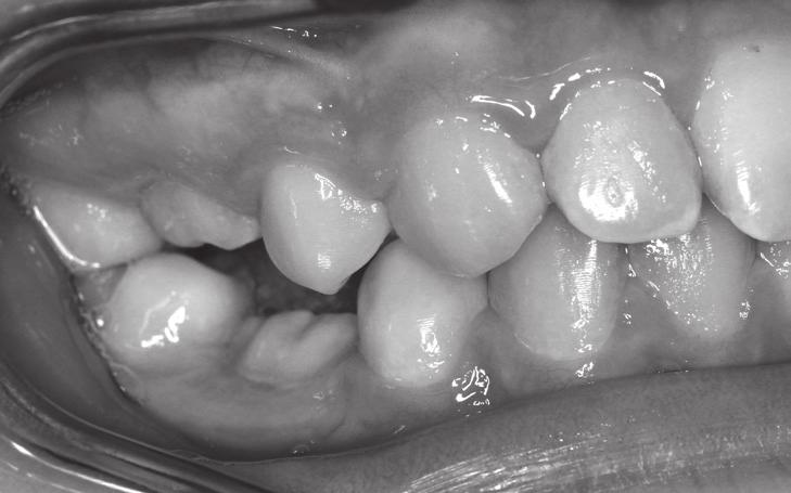 Badanie ortodontyczne u pacjentki wykazało: normę zgryzową (I klasy Angle a i I klasy kłowe) oraz klinicznie zagłębione korony zębów 55, 65, 75 i 85 (rycina 8 i 9).