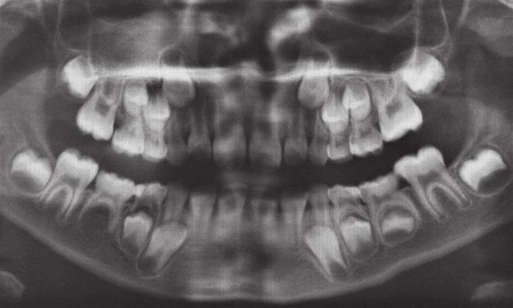 Teeth 65 and 75 in active reinclusion Rycina 10.