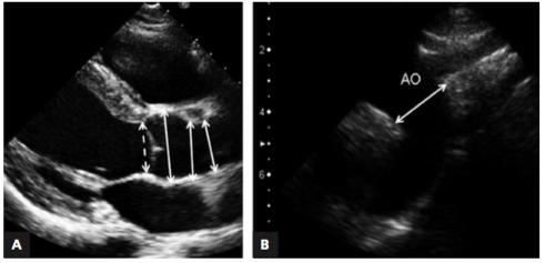 Aorta w badaniu echokardiograficznym przezklatkowym Wymiary aorty: Opuszka aorty 29 45