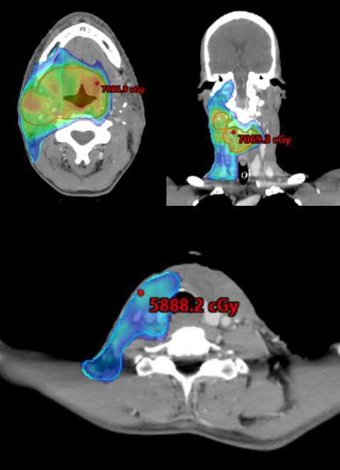 Eliminating Post-operative Radiation to the Pathologically Node Negative Neck: Long-Term Results of a Prospective Phase II Study PORT: - wszyscy otrzymali RT na lożę