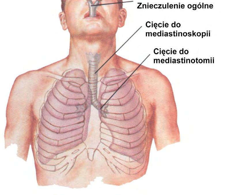 aortalno-płucnego i niektórych grup węzłów wnękowych