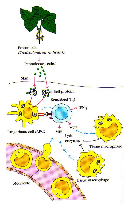 Uczulenie kontaktowe skóry - Toksyny roślinne Własne białko Uczulony limfocyt Th1 - sole Ni, barwniki do włosów