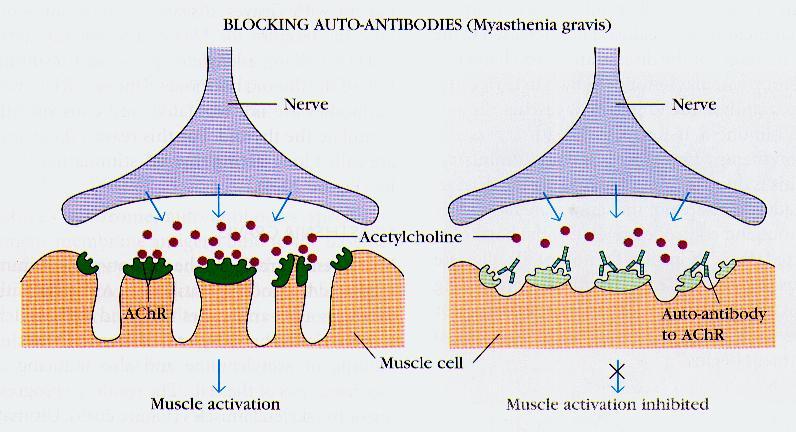 Przykłady chorób autoimmunizacyjnych (b) Myasthenia gravis: produkcja przeciwciał blokujących receptory nerw nerw acetylocholina