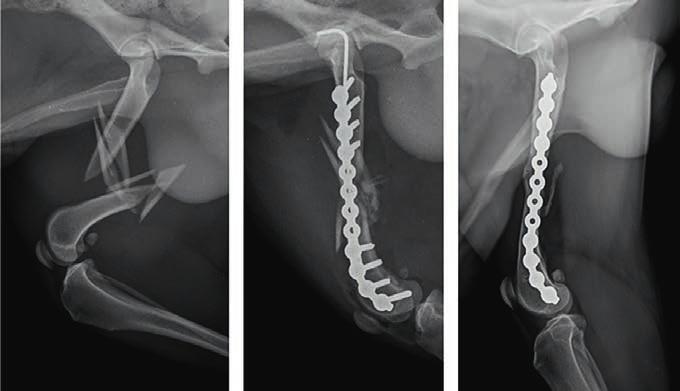 Ryc. 7. Badanie radiologiczne w projekcji profilowej. Osteosynteza wg proponowanej procedury. Ilustracje pokazują stan po urazie, w dniu zabiegu i w dniu wyjęcia płyty.