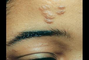 Tuberous sclerosis-stwardnienie
