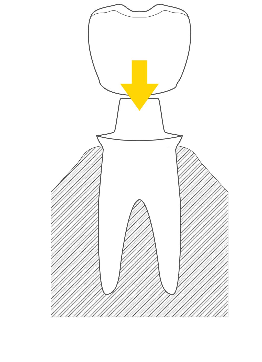 Protezy stałe: Korony protetyczne Naturalny ząb zbudowany jest z korzenia oraz z korony. Korona to widoczna w ustach cześć zęba i to właśnie od niej zależy estetyka naszego uśmiechu.
