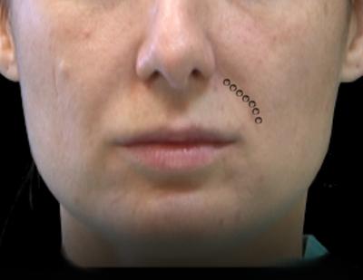 Technika punktowa ( bolus ): Technika punktowa podobnie jak liniowa jest techniką standardową w zabiegach obejmujących górną warstwę skóry.