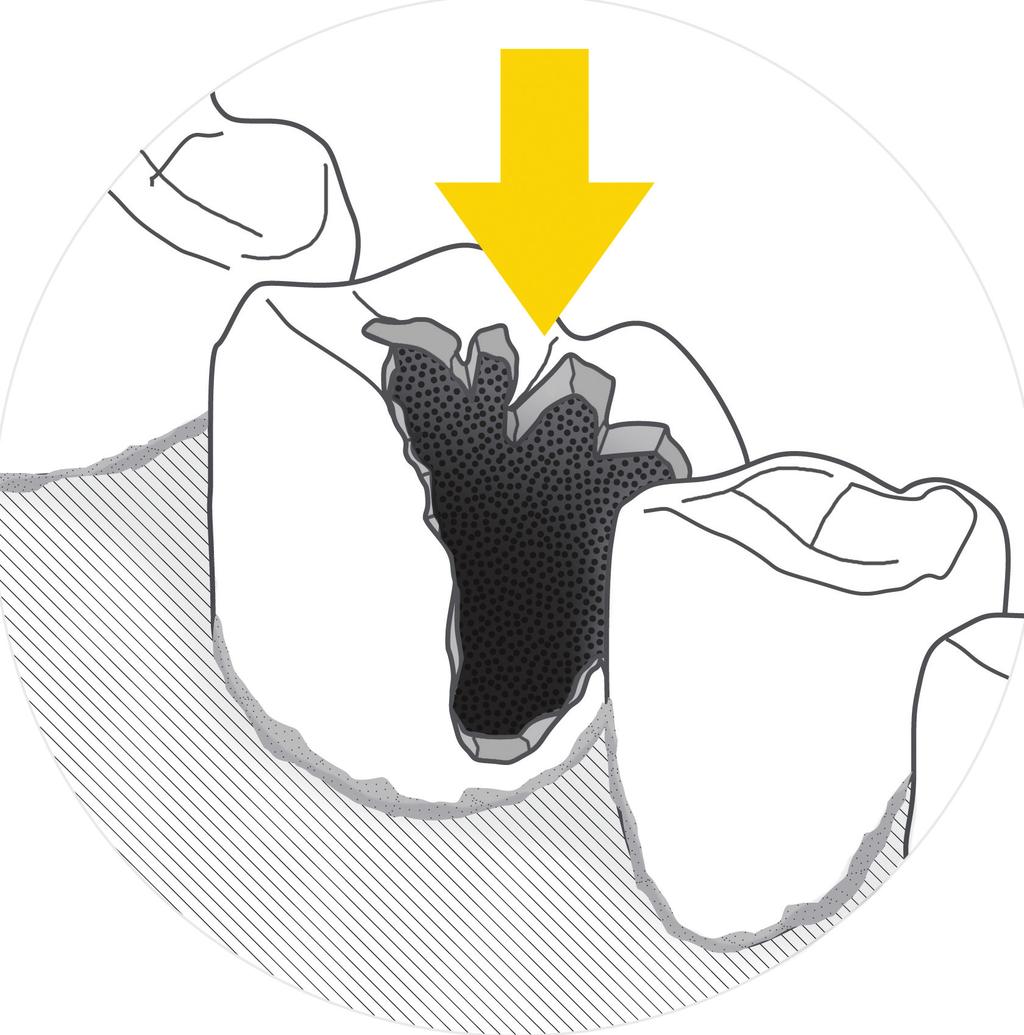 Oznaki próchnicy Próchnica w początkowym stadium bywa widoczna w postaci białych kredowych plam, nierzadko trudnych do rozpoznania, po czasie zmiany na zębach przybierają odcienie żółci, a w końcu