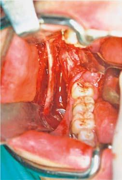 associated pneumonia). Korekta wady gnatycznej wymaga najczęściej przeprowadzenia jednoczasowej osteotomii szczęki i żuchwy (BIMAX bimaxillary osteotomy) (ryc.