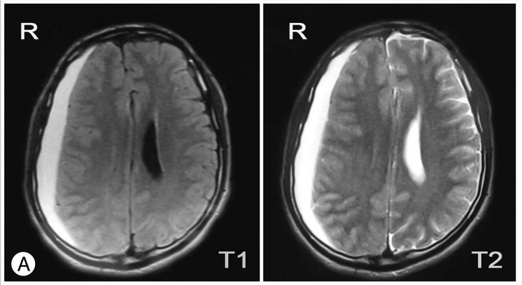 MRI Przykład