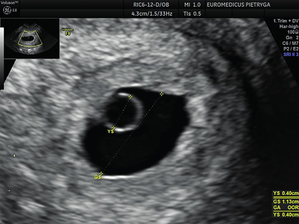Ginekologia i Perinatologia Praktyczna 2017, tom 2, nr 5 Rycina 2. Pęcherzyk ciążowy (GS) i pęcherzyk żółtkowy (YS) w 5. tygodniu ciąży (źródło: materiał własny) Rycina 3.