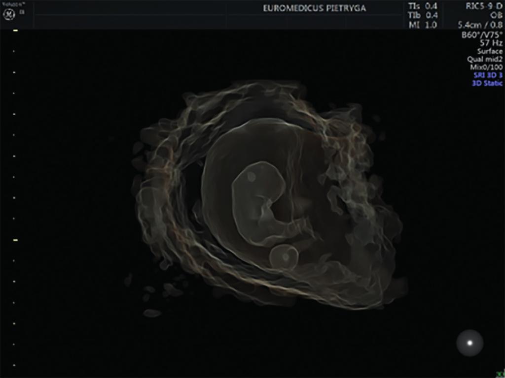 Echo zarodka płodu w badaniu metodą 3D 6.
